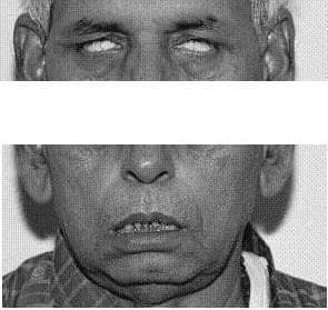 This clinical photograph displays a patient with bilateral lower motor neuron (LMN) facial nerve palsy, likely associated with Ramsay Hunt syndrome or a similar polyneuropathy. The upper panel illustrates bilateral lagophthalmos and Bell's phenomenon: when the patient attempts to close his eyes, the globes roll upward, leaving the sclera visible due to incomplete eyelid closure. The lower panel demonstrates significant facial muscle weakness and hypotonia, characterized by bilateral drooping of the oral commissures and a slack, open-mouthed appearance with visible teeth. There is a notable absence of nasolabial folds and forehead wrinkling, consistent with a complete bilateral facial nerve deficit. The educational focus is on identifying the physical signs of LMN facial paralysis, specifically the loss of motor control in the orbicularis oculi and orbicularis oris muscles, which differentiates it from upper motor neuron lesions.