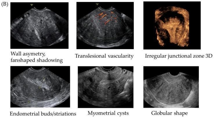 This composite educational graphic displays six ultrasound panels illustrating the classic sonographic MUSA (Morphological Uterine Sonographic Assessment) features of uterine adenomyosis. The images utilize transvaginal sonography (TVS) in grayscale, color Doppler, and 3D reconstruction. Key diagnostic signs depicted include: 1) Wall asymmetry with characteristic fan-shaped shadowing (rainshower appearance); 2) Translesional vascularity demonstrated via color Doppler, showing vessels crossing the myometrium perpendicularly; 3) An irregular junctional zone (JZ) visualized in a 3D reconstructed coronal plane; 4) Endometrial buds or striations appearing as echogenic linear structures extending from the endometrium into the myometrium; 5) Myometrial cysts, which are small anechoic fluid-filled spaces within the uterine wall; and 6) A globular uterine shape, where the uterus appears enlarged and rounded. These diagnostic criteria are essential for gynecological imaging to differentiate adenomyosis from other conditions like uterine fibroids (leiomyomas). The content is tailored for intermediate to advanced medical imaging education in obstetrics and gynecology.