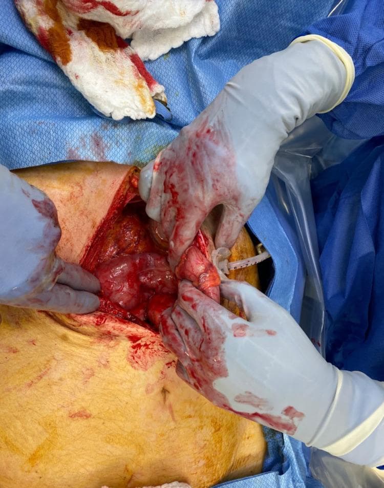 This clinical photograph displays an intraoperative view of an exploratory laparotomy. The surgical field reveals a midline abdominal incision through which internal organs, including the stomach and segments of the intestine, are visible. The tissues appear erythematous and glistening with serous and hemorrhagic fluid typical of an active surgical procedure. Surgeons' hands, wearing sterile gray nitrile or latex gloves stained with blood, are seen manipulating the abdominal viscera. A percutaneous endoscopic gastrostomy (PEG) tube is visible, emerging from the stomach/abdominal wall interface, representing the focus of the surgical intervention for malpositioning or replacement. The field is bordered by blue sterile surgical drapes, and a blood-stained surgical sponge is present in the upper left quadrant. This image illustrates the surgical management of a complication related to enteral access, specifically an intracolonic malposition of a PEG tube requiring open abdominal washout and visceral repair.