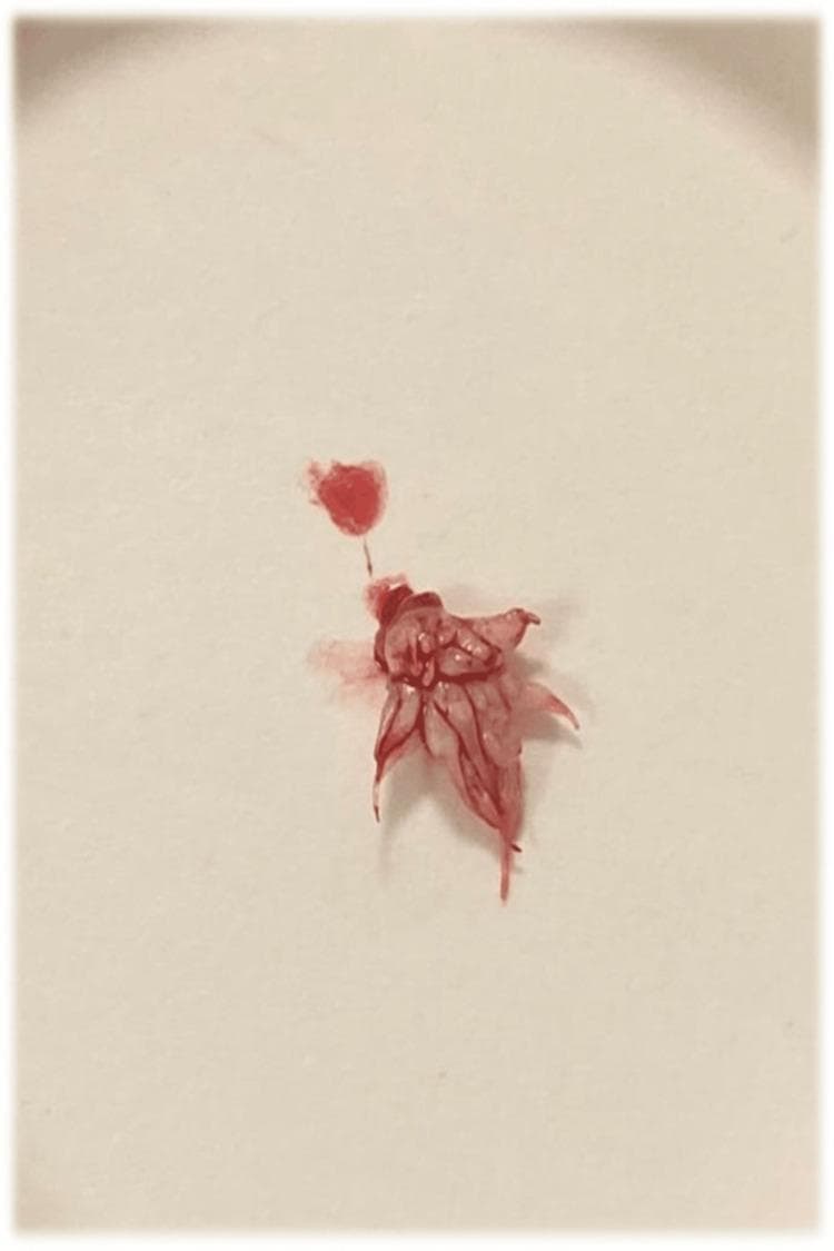This clinical photograph displays a macroscopic view of a surgically excised intraoral specimen, identified as a squamous papilloma. The lesion measures approximately 0.9 cm x 0.5 cm and exhibits a characteristic exophytic, pedunculated morphology. Its most distinctive feature is a 'feather-like' or 'cauliflower-like' configuration, consisting of numerous branching, finger-like epithelial projections radiating from a central base. The specimen is predominantly white, indicating surface hyperkeratosis, with visible focal areas of red staining due to residual blood from the excision procedure. The irregular, warty surface texture is typical of benign epithelial neoplasms of the soft palate. This image serves as a clinical example of the macroscopic presentation of an oral squamous papilloma, highlighting the relationship between the pedunculated base and the characteristic projections used for diagnostic identification in oral and maxillofacial pathology.