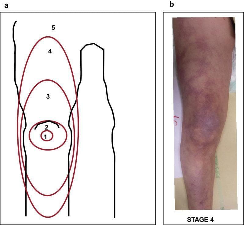 This composite educational graphic details the Mottling Score system used to assess peripheral tissue perfusion, particularly in the context of sepsis and septic shock. Panel A features an anatomical diagram of a lower limb with red concentric ellipses illustrating the semi-quantitative scoring criteria (1–5) based on the anatomical extension of skin mottling. Score 1 is localized to the patella center; score 2 reaches the superior edge of the patella; score 3 extends to the mid-thigh; score 4 reaches the groin fold; and score 5 extends beyond the groin. Panel B is a clinical photograph of a patient's leg demonstrating a high mottling score (Stage 4-5). The skin shows diffuse, reticulated, purple-to-bluish discoloration (livedo reticularis) extending from the knee upward toward the thigh and downward to the pretibial area. This visual sign represents microcirculatory dysfunction and is used as a prognostic indicator for organ failure and mortality in critically ill patients.