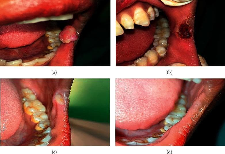 This set of four intraoral clinical photographs documents the management and healing progression of a pyogenic granuloma in the retrocommissural region. Image (a) presents the initial clinical finding: a reddish-pink, sessile, exophytic growth with a rounded morphology located on the buccal mucosa near the oral commissure. Image (b) shows the immediate postoperative appearance following surgical excision using a 980 nm diode laser; the site exhibits a charred, dark-pigmented circular wound with no active bleeding, characteristic of laser ablation. Image (c) demonstrates a follow-up stage showing significant regression and early secondary intention healing, with a small area of granulation tissue or resolving ulceration visible. Image (d) displays complete clinical resolution and mucosal healing, with no residual lesion or scarring evident in the retrocommissural area. This series serves as an educational example of oral soft tissue pathology and the efficacy of laser therapy in oral surgery for benign vascular lesions.