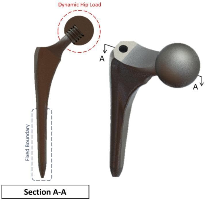 This orthopaedic engineering diagram illustrates a 3D model and cross-sectional view of a Summit hip implant used in Total Hip Replacement (THR) surgery. The visual highlights the structural components of the femoral prosthesis, including the elongated, tapered femoral stem, the neck, and the spherical femoral head (ball joint). On the left, a longitudinal cross-section (Section A-A) reveals the internal screw threads within the head-neck junction, facilitating mechanical stability. Annotations indicate biomechanical simulation parameters: a 'Fixed Boundary' is designated along the distal portion of the stem where it would be anchored within the femur, and a 'Dynamic Hip Load' is applied at the spherical head to simulate physiological articulation and stress distribution. This model is utilized in finite element analysis (FEA) to study stress concentrations, material fatigue, and the integration of SAW sensors for long-term implant monitoring. The diagram serves as an educational resource for medical students and biomedical engineers focusing on orthopaedic biomechanics and prosthesis design.