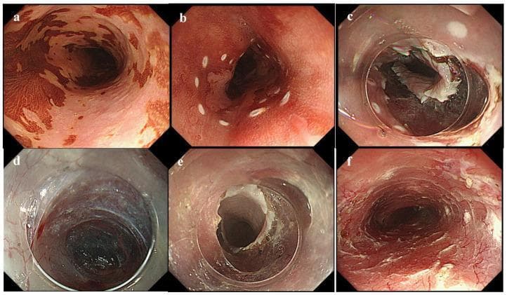 A series of six endoscopic clinical photographs (a-f) documenting the step-by-step procedure of Endoscopic Submucosal Tunnel Dissection (ESTD) for a circumferential superficial esophageal neoplastic lesion. (a) Chromoendoscopy using iodine staining highlights patchy, non-staining neoplastic areas against brown-stained healthy mucosa. (b) White circumferential coagulation markings delineate the lesion's boundaries. (c) A complete circumferential mucosal incision is shown, performed using an endoscopic knife at the distal margin. (d) Initiation of a submucosal tunnel, revealing the submucosal layer with visible vasculature. (e) Extended submucosal tunnel creation from an oral-to-anal approach, maintaining a stable dissection plane between the mucosa and muscularis propria. (f) Final post-resection view showing a large artificial ulcer after en bloc removal of the lesion. The series demonstrates advanced interventional gastroenterology techniques used to treat extensive esophageal neoplasia while preserving luminal integrity and minimizing procedural time compared to conventional endoscopic submucosal dissection (ESD).
