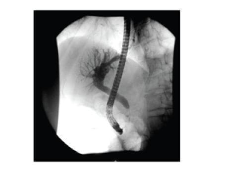 This diagnostic fluoroscopic image is an Endoscopic Retrograde Cholangiopancreatography (ERCP) spot film showing the hepatobiliary system. The image reveals a prominent stricture in the proximal common bile duct (CBD), characterized by a segment of narrowing. Proximal to this obstruction, there is significant dilatation of the intrahepatic biliary tree and the distal biliary segments, indicating upstream biliary stasis. A radiopaque 10F pigtail biliary stent has been deployed across the stenotic region to restore patency and facilitate biliary drainage. The side-viewing endoscope used for cannulation is visible within the duodenum. The clinical significance of this finding relates to the evaluation of obstructive jaundice, where the differential diagnosis includes malignant compression (e.g., pancreatic head mass) or benign inflammatory conditions like Mirizzi syndrome or chronic pancreatitis. This image serves as a high-level educational example of interventional endoscopy and biliary anatomy management.