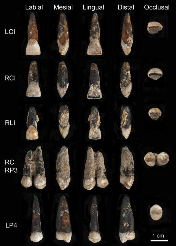 A clinical photograph of six permanent maxillary hominin teeth from the Magubike archaeological site, presented in multiple orientations: Labial, Mesial, Lingual, Distal, and Occlusal views. The specimen set includes the left central incisor (LCI), right central incisor (RCI), right lateral incisor (RLI), right canine (RC) cemented with the right third premolar (RP3), and the left fourth premolar (LP4). The teeth exhibit significant taphonomic erosive damage, characterized by partial dissolution of the enamel and rough, granular surface textures across the crowns and roots. Coloration varies from light enamel tones to dark, mottled brown/black staining, particularly on the roots and proximal surfaces. The occlusal views demonstrate diverse wear patterns, with the incisors showing irregular shapes and dark bands across biting surfaces, and the canine/premolar complex revealing distinct cusp morphology (single cusp on RC, bicuspid on RP3). This display serves as an educational resource for studying dental anthropology, paleopathology, and taphonomic degradation of human dental tissues.