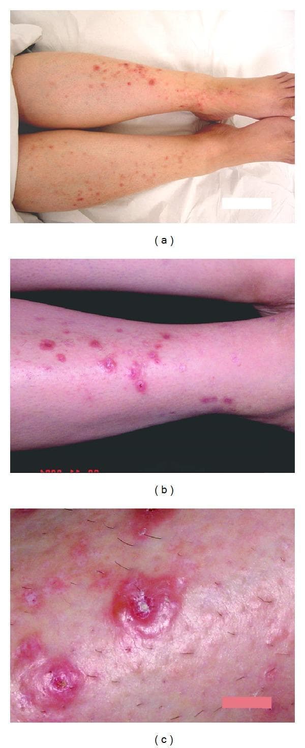 This set of clinical photographs demonstrates a bilateral and nearly symmetrical distribution of skin lesions on the anterior lower legs of a patient with uncontrolled type 2 diabetes. (a) An overview showing multiple, scattered, discrete vesicles and papules across the tibial surfaces. (b) A higher magnification view reveals tense, fluid-filled vesicles (3–7 mm) situated on an erythematous base, alongside lesions showing signs of umbilication and central crusting. (c) A close-up detail highlights the progression of the lesions from acute tense blistering to central crustations and the formation of fine, white, depressed (atrophic) scars in healed areas. The clinical presentation is characteristic of bullosis diabeticorum (diabetic bullae), illustrating the evolution from acute intraepidermal separation to scar formation in the context of poor metabolic control and impaired wound healing.