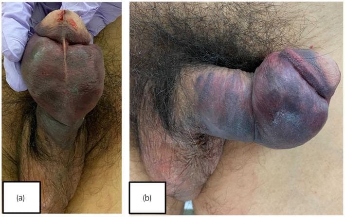 Two clinical photographs (a and b) show a male pelvis and genitalia demonstrating classic signs of penile fracture. The penis exhibits a characteristic 'eggplant deformity,' characterized by gross swelling, distortion, and a large subcutaneous hematoma. The skin of the penile shaft and glans is markedly discolored with deep purple and blue ecchymosis, extending from the distal ventral surface to the proximal shaft. Figure (a) provides a ventral view showing maximal tumescence and hematoma concentration at the distal shaft, while figure (b) provides a lateral view highlighting the circumferential nature of the swelling and the involvement of the glans. Hemorrhage is also visible at the external urethral orifice, suggesting a concomitant urethral injury. This visual presentation is indicative of a rupture of the tunica albuginea, often occurring during high-impact trauma to the erect penis. The images serve as an educational tool for identifying emergency urological conditions requiring immediate surgical intervention to preserve erectile and urinary function.