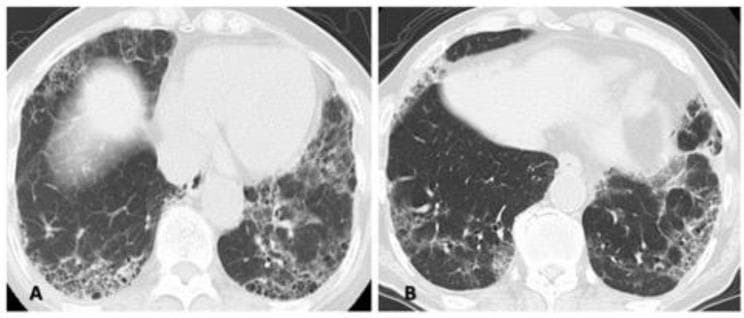 Two high-resolution computed tomography (HRCT) axial lung window images (A and B) demonstrating interstitial lung disease (ILD) patterns with overlapping features. Case A (left) shows a combination of diffuse ground-glass opacities (GGO), particularly in the right lung, and subpleural reticulation. Peripheral honeycombing is visible in the posterior lower lung fields, creating a mixed picture of nonspecific interstitial pneumonia (NSIP) and usual interstitial pneumonia (UIP). Case B (right) reveals predominant peripheral and subpleural reticular opacities and honeycombing in the bilateral lower lobes, more pronounced on the left side, which are classic hallmarks of a UIP pattern. These images illustrate the diagnostic challenge of 'unclassifiable' or 'mixed' patterns in rheumatology-associated ILD, where inflammatory (NSIP-like) and fibrotic (UIP-like) components coexist. Key educational features include the distinction between reversible GGO and irreversible honeycombing/traction bronchiectasis in the context of progressive fibrosing interstitial lung disease (PF-ILD).