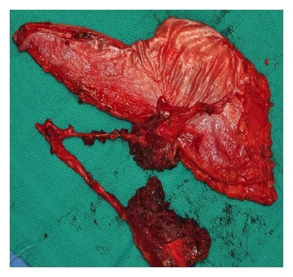 This clinical photograph shows a harvested anterolateral thigh (ALT) free flap, a versatile fasciocutaneous flap used in reconstructive surgery. The specimen is displayed against a green surgical drape immediately following harvest. The flap is composed of a large cutaneous portion and a complex vascular pedicle. Notably, the tissue has been divided into separate skin islands based on multiple perforators branching from the main descending branch of the lateral circumflex femoral artery. The vascular pedicle is visible as a long, branching structure with patent vessels and associated cuff of connective tissue. The deep surface of the flap shows the fascia and subcutaneous adipose tissue, which appears highly vascularized with a reddish-pink hue. This image illustrates the anatomical basis for creating chimera or multi-paddle flaps, allowing a single donor site to reconstruct non-contiguous defects, such as combined intraoral and extraoral maxillofacial defects. This is a key concept in advanced plastic and reconstructive surgery, highlighting the flap's adaptability in complex head and neck reconstruction.
