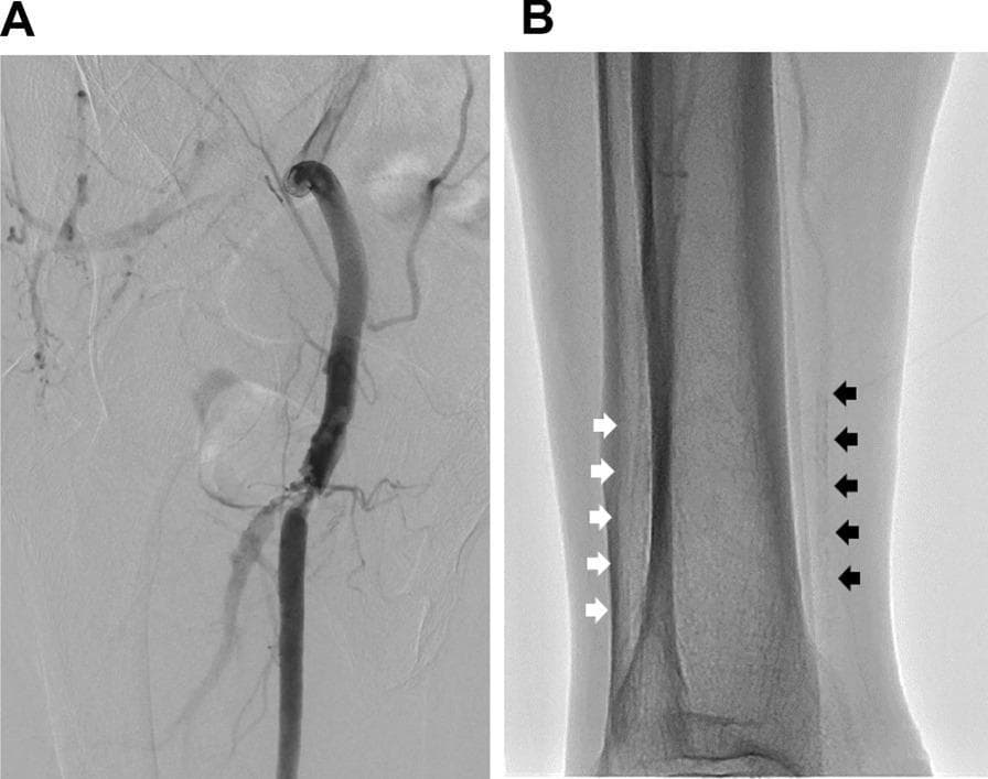 This composite of diagnostic images illustrates peripheral artery disease (PAD) in the right lower extremity. Image A is a Digital Subtraction Angiography (DSA) of the right thigh, showing the common femoral artery bifurcation. A severe focal stenotic lesion is visible at the origin of the right superficial femoral artery (SFA), characterized by a localized narrowing of the contrast column and reduced enhancement indicating restricted blood flow. Image B is a non-contrast fluoroscopic image of the right lower leg (calf) near the ankle. It demonstrates extensive medial arterial calcification (Mönckeberg sclerosis), a common finding in long-standing diabetes mellitus. White arrows indicate linear radiopaque deposits along the course of the anterior tibial artery, while black arrows highlight similar severe calcifications of the posterior tibial artery. These images demonstrate the coexistence of proximal atherosclerotic stenosis and distal infrapopliteal arterial stiffness, which can lead to falsely elevated or normal ankle-brachial index (ABI) measurements due to vessel incompressibility.