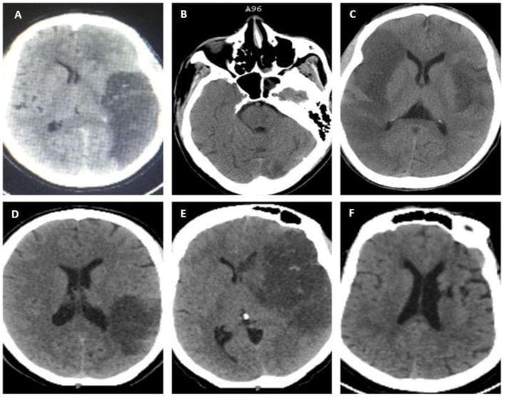 This composite of six axial non-contrast computed tomography (NCCT) brain scans illustrates various patterns of ischemic stroke across different vascular territories. Panel (A) demonstrates a hypodense infarct in the left distal middle cerebral artery (MCA) M1 territory with signs of Hemorrhagic Infarction type 1 (HI1). Panel (B) shows a basilar artery and left posterior cerebral artery (PCA) infarction, highlighted by a hyperdense basilar sign indicative of acute thrombus. Panel (C) presents bilateral MCA involvement, affecting the right M1 and left distal M1/proximal M2 segments. Panel (D) reveals a focal hypodensity in the inferior division of the left M2 MCA territory with HI1 features. Panel (E) shows a large territory infarct in the left proximal M1 segment with HI1. Panel (F) depicts a small, localized left lacunar infarct, representative of non-large vessel occlusion (non-LVO). The collection serves as an educational comparison for identifying stroke topographies, large vessel occlusion (LVO) signs, and petechial hemorrhagic transformation on baseline NCCT imaging.