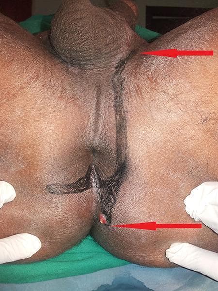 This clinical photograph displays the perianal and perineal region of a patient in the lithotomy position, used for surgical or diagnostic mapping of an anal fistula. The primary finding is an active external sinus tract opening located inferior to the anus, characterized by a visible nodule with slight erythema. Dark, linear markings have been applied to the skin to delineate the suspected subcutaneous course of the fistulous tracts. One marking extends superiorly from the anal region toward the base of the scrotum, while another extends laterally toward the right gluteal region. Red arrows highlight the distal and proximal extents of these tracts. This image is an educational example of preoperative fistula-in-ano assessment and the clinical manifestation of complex perianal disease, demonstrating how external markings correlate with underlying pathology for surgical planning or thread placement (e.g., Ksharasutra therapy).