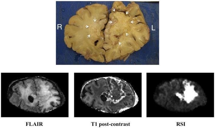 This educational image presents a clinicopathologic correlation between a gross pathology specimen and multi-parametric Magnetic Resonance Imaging (MRI) of the brain. The top panel shows a coronal gross pathologic section through the frontal lobes, labeled right (R) and left (L). The left hemisphere contains a large, demarcated area of yellowish, caseous coagulative necrosis (indicated by white arrows) resulting from bevacizumab-related treatment effects. A smaller, similar lesion is visible in the right hemisphere. The bottom panel provides corresponding coronal MRI sequences for clinical correlation: 1) FLAIR shows heterogeneous hyperintensity throughout the left frontal lobe indicating vasogenic edema and tissue changes. 2) T1 post-contrast demonstrates a prominent, irregular ring-enhancing lesion in the left hemisphere, signifying a breakdown of the blood-brain barrier. 3) Restriction-Spectrum Imaging (RSI) reveals a striking, homogeneous bright signal in the region of the necrosis, indicating marked restricted diffusion. This sequence allows for the differentiation of treatment-induced necrosis from recurrent high-grade glioma, which typically presents with more heterogeneous restricted diffusion and higher perfusion values.