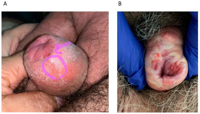 Clinical photograph comparison of two cases of local recurrence of penile squamous cell carcinoma following previous penis-sparing surgery. Image A displays a recurrence at the neoglans and foreskin interface characterized by a raised, hyperkeratotic, and scaly plaque, highlighted by a pink circle and arrow, suggesting a superficial verrucous or squamous growth. Image B demonstrates a more aggressive multifocal recurrence on the neoglans surface, presenting with deeply erythematous, friable, and ulcerated lesions, indicating increased vascularity and potential tissue erosion. Both images highlight the importance of post-glansectomy surveillance. These clinical signs are critical for identifying penile intraepithelial neoplasia (PeIN) or invasive squamous cell carcinoma recurrences in patients who have undergone glansectomy or partial penectomy.