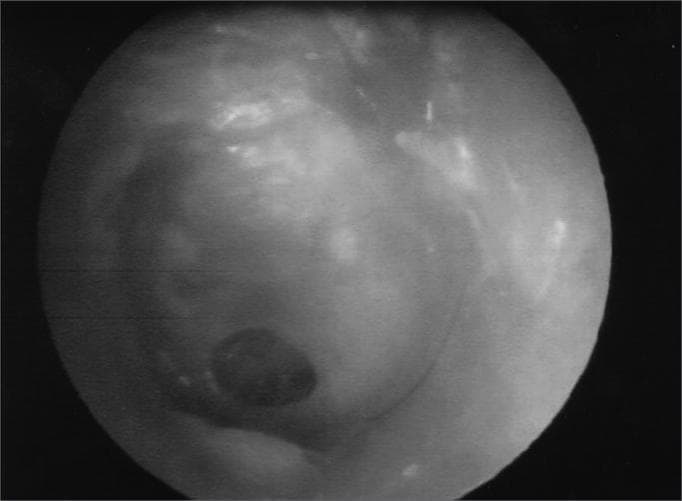 This clinical photograph, captured via otoscopy or endoscopy, displays a human tympanic membrane (eardrum) with a prominent central perforation. The tympanic membrane appears grayish-white and translucent in intact regions, with visible light reflections indicating a smooth surface texture. The central feature is a dark, well-demarcated, roughly circular or oval opening (perforation) located within the pars tensa. The edges of the perforation are sharp and appear non-inflamed, with no immediate evidence of active infection, drainage, or cholesteatoma in the visible field. This image serves as a classic educational representation of chronic otitis media or traumatic eardrum injury, illustrating the loss of membrane integrity that can lead to conductive hearing loss. The visualization provides a clear example for medical students and otolaryngologists to study eardrum morphology and the anatomical localization of tympanic defects prior to surgical intervention, such as tympanoplasty.