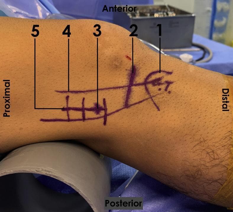 This clinical photograph displays the lateral aspect of a right human knee flexed at approximately 30 degrees, prepared for a surgical procedure (likely iliotibial band lengthening). Preoperative purple skin markers identify key surface anatomy landmarks and surgical planning lines. Numbered labels indicate: (1) Gerdy’s tubercle at the distal insertion of the iliotibial band (ITB); (2) the lateral tibiofemoral joint line; (3) the lateral femoral epicondyle; (4) the longitudinal axis and path of the ITB along the lateral thigh; and (5) the planned 4-cm lateral incision site. Visible distal to the joint line is a 'Z' configuration marking, indicating a planned Z-plasty for ITB lengthening. The image illustrates the anatomical orientation (proximal, distal, anterior, posterior) and the relationship between palpable landmarks and the surgical approach used for treating iliotibial band syndrome in an orthopedic clinical setting.