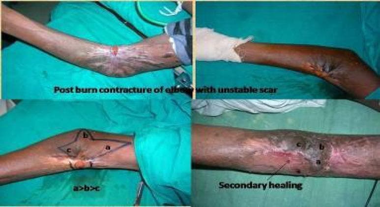 A composite of four clinical photographs demonstrating the preoperative state and surgical planning for a post-burn elbow contracture. The top panels show the affected arm with extensive scarring, hyperpigmentation, and hypopigmentation, illustrating an unstable scar and significant flexion contracture of the elbow joint. The bottom-left panel details the preoperative surgical markings for a trilobed perforator flap. The markings define three adjacent skin flaps labeled 'a', 'b', and 'c' in descending order of size (indicated by the notation 'a>b>c'), designed to be rotated to release the contracture. The bottom-right panel displays the area after initial surgical steps or secondary healing, with labels corresponding to the planned flap locations. This sequence illustrates the reconstructive plastic surgery approach using a specialized perforator flap technique to restore joint mobility and skin integrity in a patient with severe thermal injury sequelae.