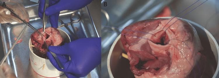 This clinical photograph displays a side-by-side comparison (labeled A and B) of a cardiac surgical simulation involving a porcine heart specimen. Panel A illustrates the active phase of suture placement at the aortic annulus. Visible instruments include needle drivers, surgical forceps, and scissors being used by a surgeon in blue gloves to place sutures at the nadir of the aortic valve cusps. The suture threads appear loose and unorganized at this stage. Panel B shows the same specimen after initial suture placement. The surgical instruments are removed, and the blue suture threads are organized and pulled taut, radiating superiorly from the annulus. This configuration creates guide paths intended to facilitate the descent of a prosthetic valve into the aortic lumen. The images demonstrate key technical steps in valve replacement surgery, focusing on annular suturing and thread management to ensure proper prosthetic seating.