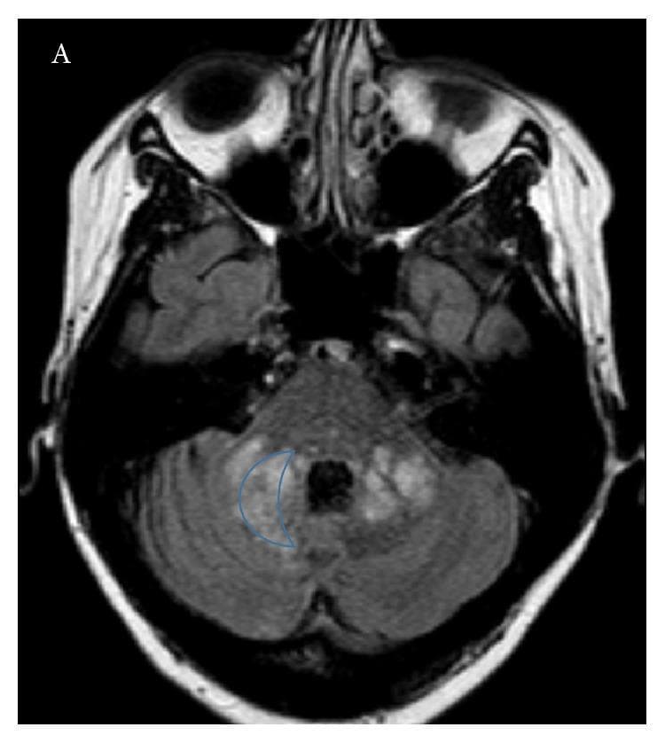 This diagnostic image is an axial T2-weighted or Fluid-Attenuated Inversion Recovery (FLAIR) MRI scan of the brain at the level of the posterior fossa. The image demonstrates bilateral, asymmetric hyperintense lesions within the middle cerebellar peduncles and adjacent cerebellar white matter. Notably, a lesion on the left side (right side of the image) is outlined to highlight its characteristic 'crescent' shape, a morphology often associated with progressive multifocal leukoencephalopathy (PML). The hyperintensity indicates demyelination or inflammatory changes, which are distinguishable from the surrounding normal brain tissue. The clinical context provided suggests these findings represent a complication of natalizumab therapy in a patient with relapsing-remitting multiple sclerosis (RRMS), leading to opportunistic JC virus infection. This imaging is critical for differentiating PML from typical MS relapses, as the specific involvement of the cerebellar peduncles and the crescentic shape are hallmark diagnostic features for clinicians and radiologists.