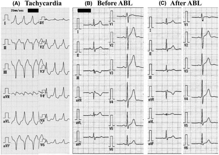 This diagnostic image displays three 12-lead electrocardiograms (ECGs) from a 33-year-old patient, comparing cardiac activity during tachycardia and sinus rhythm before and after catheter ablation. Panel (A) shows a wide QRS complex tachycardia characterized by a superior axis and positive concordance across the precordial leads (V1-V6). Panel (B) demonstrates a baseline 12-lead ECG in sinus rhythm before the procedure, showing no evidence of ventricular pre-excitation (no delta waves). Panel (C) captures the ECG following catheter ablation (ABL) of a Mahaim fiber. Key post-procedural changes include a significant increase in the R-wave amplitude in lead III and a rightward QRS axis shift from 12° to 59°. The comparison highlights subtle ECG indicators of successful ablation in cases of Mahaim-type accessory pathways where pre-excitation is not visible during normal sinus rhythm. This material is used to teach electrophysiological mapping and the interpretation of axis changes in supraventricular tachycardia management.