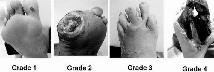 A comparative clinical photograph set illustrating the Wagner Classification System for diabetic foot ulcers across four stages (Grade 1 to Grade 4). Grade 1 (Superficial Ulcer) shows a small, localized skin lesion on the plantar surface near the base of the toes with no deep tissue involvement. Grade 2 (Deep Ulcer) depicts a larger, deeper wound penetrating to the tendon or joint capsule without abscess or osteomyelitis. Grade 3 (Osteitis/Infection) demonstrates a deep ulcer associated with significant inflammation, purulent discharge, and clinical signs of underlying bone infection or deep tissue abscess. Grade 4 (Forefoot Gangrene) shows extensive necrosis and blackening of the tissue localized to the forefoot or toes, indicating severe vascular compromise and tissue death. This series serves as an educational tool for medical professionals to differentiate between stages of diabetic foot pathology, guiding clinical management and prognosis assessment.