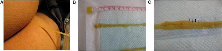 A series of clinical photographs documenting the extraction and gross morphology of a tapeworm (Cestoda). Figure A shows a long, yellowish, ribbon-like structure being carefully extracted from a patient's anal region into a clear plastic bag to maintain specimen integrity. Figure B displays the parasite post-extraction against a measuring tape and blue absorbent pad, highlighting its significant length, flat morphology, and a spoon-shaped scolex (head). Figure C provides a close-up view of the parasite's strobila, revealing distinct proglottids (segments). Black arrows point to central dark spots within the segments, which represent the gravid uterus. This image serves as a clinical reference for parasitic helminth infections, specifically diphyllobothriasis associated with the consumption of raw fish. Key educational features include the visualization of the scolex, proglottid segmentation, and macroscopic diagnostic characteristics used in identifying cestode species.