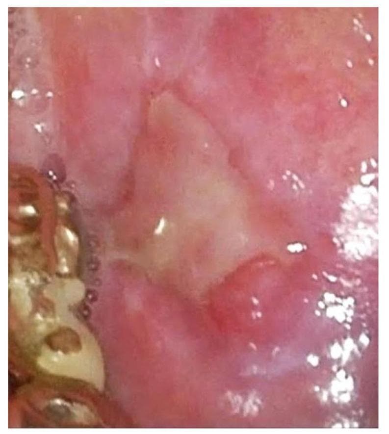 This clinical photograph, captured via white light imaging (WLI) oral endoscopy, demonstrates an ulcerated erythroplasic lesion on the oral mucosa. The central portion of the lesion features an irregular, yellowish-white fibrinous base characteristic of ulceration, surrounded by a distinct area of intense red discoloration (erythroplakia). The adjacent peripheral mucosa exhibits diffuse erythema, suggesting associated inflammation or increased vascularity. On the left side of the frame, orthodontic hardware or a dental appliance is visible, providing anatomical context within the oral cavity. This image is used to illustrate premalignant or malignant mucosal changes, such as squamous cell carcinoma or severe dysplasia, highlighting the importance of recognizing combined red and white (erythroleukoplakia) patterns during clinical examination.
