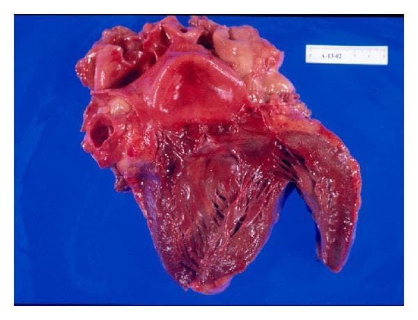 This clinical photograph displays a gross pathology heart specimen from an autopsy, illustrating an acute subendocardial-myocardial infarction. The heart is shown in a coronal dissection, revealing the internal ventricular architecture and myocardial wall. A clear demarcation is visible: the superior/basal portion of the myocardium exhibits a bright red, smooth, and glistening appearance, while the inferior and subendocardial regions transition to a darker, dusky red hue with a more granular and roughened texture. This color and textural shift corresponds to areas of myocardial necrosis and hemorrhage, likely related to systemic stressors such as heat stroke. Key anatomical features include the trabeculae carneae of the ventricular walls and the papillary muscles. A metric scale is present in the upper-right corner for size reference. This image is an educational tool for pathology students to identify gross macroscopic changes associated with myocardial ischemia and infarction in a clinical forensic context.