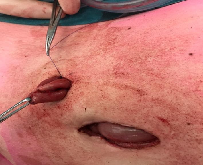 This clinical photograph captures an intraoperative view of a surgical stoma creation, likely an ileostomy or colostomy, following bowel transection. A segment of reddish-pink, viable bowel is being exteriorized through a small circular skin incision in the abdominal wall. Surgical forceps are visible, grasping the tip of the exteriorized bowel segment to facilitate manipulation. A purple monofilament suture, held by a needle driver, is seen at the superior margin of the stoma site, representing the oversewing of a previously stapled line to control the stoma's diameter. Inferior to the primary stoma site, a larger secondary surgical opening reveals a distended loop of bowel beneath the skin surface, illustrating the clinical challenge of creating a stoma from dilated bowel. The surrounding skin exhibits generalized erythema and mottling, consistent with surgical prep and mechanical manipulation. The image demonstrates the 'cone stoma' technique intended to reduce mucocutaneous separation and parastomal complications by limiting the diameter of the exteriorized segment.