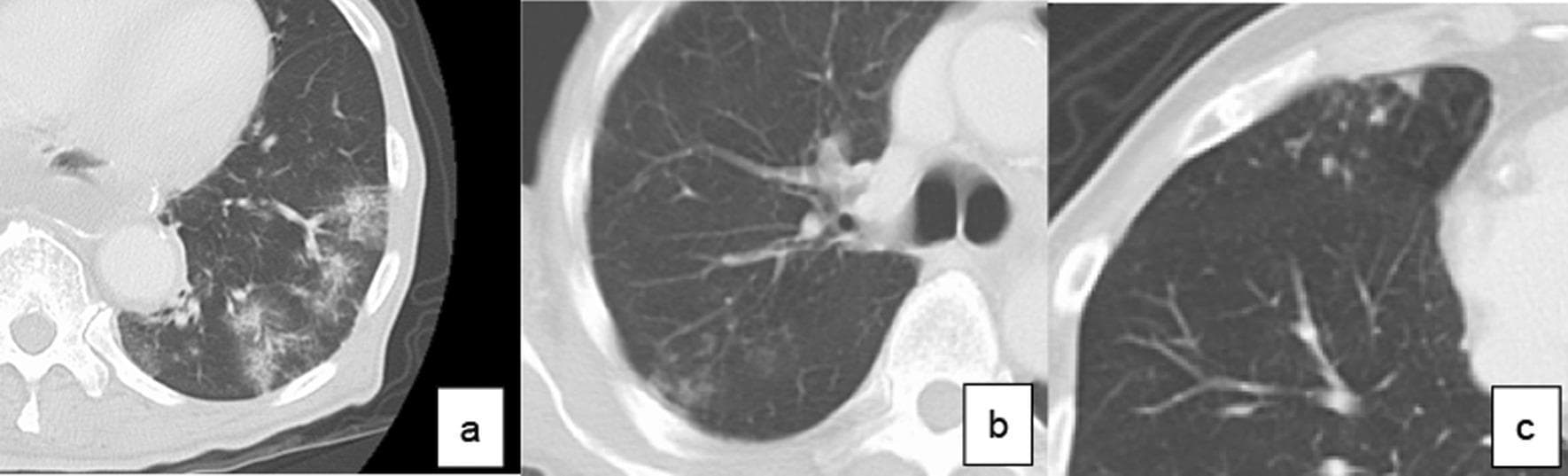 A comparison chart consisting of three axial chest CT scans illustrating radiological classifications of pneumonia. Panel (a) shows the consolidation type, characterized by areas of increased pulmonary density and patchy opacification within the lung parenchyma, consistent with alveolar filling that obscures underlying vascular structures. Panel (b) depicts the reticular type, showing a fine, net-like meshwork of linear opacities reflecting interstitial involvement or thickened interlobular septa. Panel (c) illustrates the nodular type, marked by multiple discrete, rounded opacities or small nodules scattered within the lung field. These images serve as educational reference for identifying long-term postoperative pneumonia (LTPP) patterns, emphasizing the morphological distinctions between alveolar consolidation, interstitial linear patterns, and nodular presentations. The imaging modality is high-resolution computerized tomography (CT), focused on the thoracic cavity and lung parenchyma for diagnostic classification in respiratory medicine.