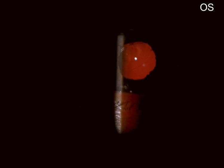 This clinical photograph shows a slit-lamp examination of the left eye (OS) in a post-operative state following cataract surgery. The image demonstrates a clear anterior chamber and pseudophakia, evidenced by a centrally positioned intraocular lens (IOL). A prominent, bright red reflex (red glow) fills the pupillary aperture, indicating a clear visual axis through the IOL to the fundus. The pupil is slightly irregular in shape. A vertical slit-lamp light beam is visible on the left side of the iris and cornea, providing cross-sectional illumination that reveals the depth of the anterior segment. Within the red reflex, a sharp, white punctate reflection is visible on the anterior surface of the IOL, along with a subtle curved edge of the lens optic. This diagnostic image is used in ophthalmology to confirm the correct placement of a posterior chamber intraocular lens and to assess the clarity of the ocular media after surgical intervention.