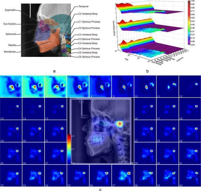 This composite educational graphic illustrates the Ageing-Related Distribution of Ageing (ARDA) in lateral cephalometric radiography (LCR).
Panel A displays an anatomical diagram of a lateral skull radiograph with color-coded regions-of-interest (instances), including the eye socket, maxilla, mandibular bone, and cervical vertebrae C1-C5. Panel B presents a 3D quantitative distribution chart plotting age (4-40 years) against specific anatomical instances and quantified ARDA values. The three stacked surface plots represent different ageing-significant region thresholds (median, 75th, and 90th percentiles), showing how salience concentrated in local regions as subjects aged.
Panel C provides a multi-frame heatmap progression, mapping average ageing salience across different ages. A central large LCR image of a 28-year-old subject shows the heatmap overlay, where a blue-to-red color gradient indicates low-to-high ageing salience. High salience is notably concentrated in the temporal bone and teeth regions. This visualization demonstrates that human development information is widely distributed across the craniofacial structure in early childhood, while ageing markers become localized in specific dental and skeletal regions after age 12.