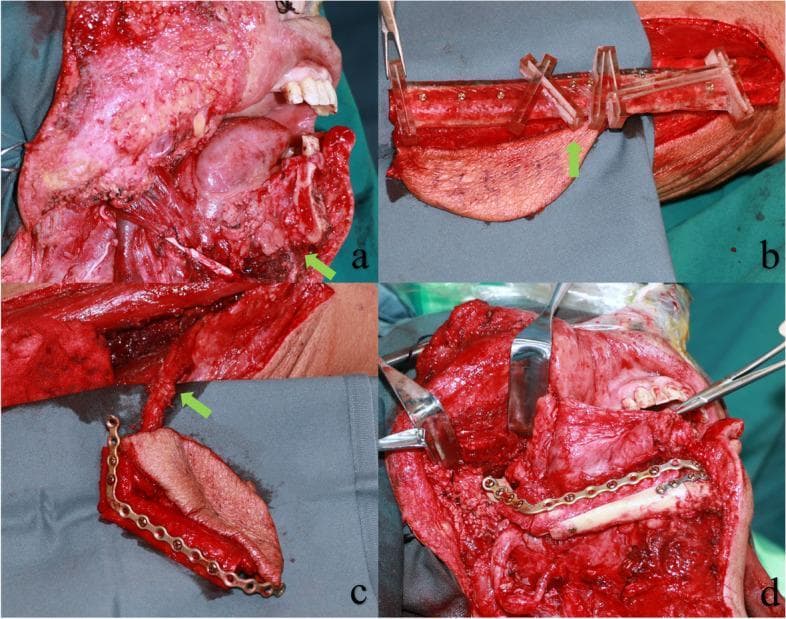 This composite of four clinical photographs illustrates a mandibular reconstruction using a free fibula flap guided by MOPITS (mandibular and osteotomy precision-improving template system). (a) Intraoperative view of a significant mandibular defect following tumor resection. (b) Preparation of the donor fibula segment; a clear resin surgical template is secured with screws to guide precise osteotomies and shaping of the bone. (c) The harvested fibular segment and associated skin paddle, featuring a pre-bent titanium reconstruction plate affixed to the bone to replicate the mandibular contour. The green arrow indicates the vascular pedicle containing the peroneal artery and veins for microsurgical anastomosis. (d) The final reconstruction stage, showing the vascularized fibular flap secured to the native mandibular remnants with the titanium plate and screws, restoring the anatomical continuity of the lower jaw. This surgical series demonstrates oral and maxillofacial reconstructive techniques, emphasizing the use of 3D-planned surgical guides for accuracy in free tissue transfer.