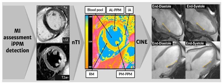 Educational diagram illustrating a Cardiac Magnetic Resonance (CMR) image analysis workflow for myocardial infarction (MI) assessment and infarcted papillary muscle (iPPM) detection. The figure is organized into three sequential sections from left to right. The first section displays short-axis views using Late Gadolinium Enhancement (LGE) and T2-weighted (T2w-) sequences to visualize myocardial tissue characterization. The central section features a native T1 (nT1) map with segmented regions of interest (ROIs) labeled: Blood Pool (BP), Anterolateral Papillary Muscle (AL-PPM), Posteromedial Papillary Muscle (PM-PPM), Infarcted Area (IA), and Remote Myocardium (RM). A color scale bar indicates nT1 values ranging from 900 to 1400 ms. The right section displays CINE long-axis sequences in two-chamber (upper) and four-chamber (lower) views, comparing the left ventricle at end-diastole and end-systole. Yellow calipers measure longitudinal strain, demonstrating ventricular contraction. This composite image serves to teach multimodal CMR techniques for evaluating ischemic heart disease and papillary muscle involvement.