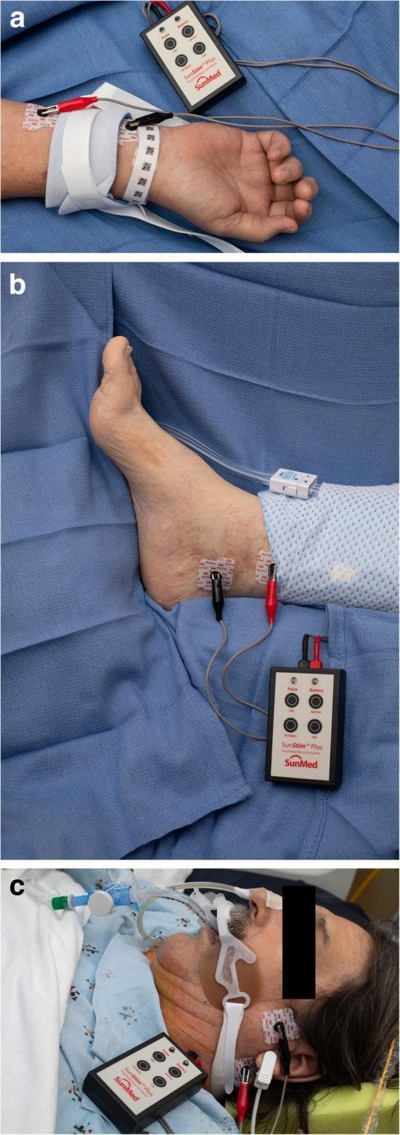 A three-panel clinical photograph demonstrating the application of a peripheral nerve stimulator (PNS) at different anatomical sites for monitoring neuromuscular blockade. Panel (a) shows the SunStim™ Plus device connected via red and black electrodes to the ulnar nerve at the wrist, notable for the presence of a white limb restraint. Panel (b) illustrates the device connected to the posterior tibial nerve at the medial malleolus of the ankle. Panel (c) shows the PNS electrodes placed over the facial nerve branches near the jawline and ear of a patient who is intubated with a secured endotracheal tube. The series highlights common sites for Train-of-Four (TOF) monitoring in an Intensive Care Unit (ICU) or perioperative setting, particularly when patient positioning or restraints limit access to the standard adductor pollicis muscle. Key educational concepts include electrode placement for nerve stimulation, the influence of monitoring site selection on the assessment of neuromuscular recovery, and the management of patients receiving neuromuscular blocking agents (NMBAs).