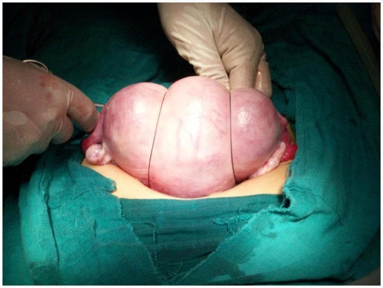 This clinical photograph demonstrates an intraoperative view of a uterine compression suture technique, specifically a B-Lynch or similar brace suture procedure, used to manage postpartum hemorrhage (PPH). The exteriorized uterus is shown as a large, globular, pinkish-red organ. Two dark-colored, non-resorbable sutures are visible encircling the uterine fundus vertically, creating longitudinal grooves and visible tissue compression. These sutures act as braces to provide mechanical compression of the myometrium, facilitating hemostasis by reducing the uterine volume and compressing intramyometrial blood vessels. A gloved hand is shown applying manual pressure to the fundus, assisting in the placement and tightening of the suture. The surgical field is prepared with green sterile drapes. This visual is significant for obstetric education, illustrating a key life-saving surgical intervention when conservative management of uterine atony fails.
