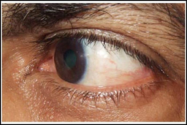 This clinical photograph shows a close-up, lateral view of a human left eye three months after pterygium excision and conjunctival autograft (CAG) surgery. The focus is on the temporal bulbar conjunctiva and the corneal-limbal interface. The cornea is largely clear and transparent, with a smooth, reflective surface. The site of the previous temporal pterygium exhibits a healthy conjunctival autograft that has successfully integrated, showing minimal residual thickening or scarring at the limbus. There is a mild degree of conjunctival injection (vascularization) visible in the temporal region, which is expected during the late postoperative recovery phase. The sclera remains naturally white with some fine episcleral vessels. No significant recurrence of the fibrovascular growth is observed on the corneal surface, demonstrating a stable surgical outcome for temporal pterygium management. The iris and pupil appear normal behind the clear corneal window.