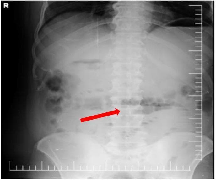 This diagnostic image is an erect anteroposterior (AP) abdominal plain film radiograph. The imaging reveals signs consistent with a small bowel obstruction. Key findings include mildly dilated loops of the small bowel localized primarily in the central abdomen. Multiple horizontal air-fluid levels are visible within these dilated segments, a classic radiographic sign of intestinal stasis or mechanical obstruction. A red arrow specifically highlights one such air-fluid level within a small bowel loop. Additionally, the stomach shows distention with a prominent air collection and an internal fluid level. The overall gaseous distribution is abnormal, with a lack of significant gas in the distal colon or rectum visible in this view. In the clinical context of Rigler's triad, these findings support a diagnosis of gallstone ileus, where a large ectopic gallstone causes mechanical small bowel obstruction. This radiographic study is a primary educational example for medical students and radiology residents to identify bowel dilation and obstructive patterns on plain film imaging.
