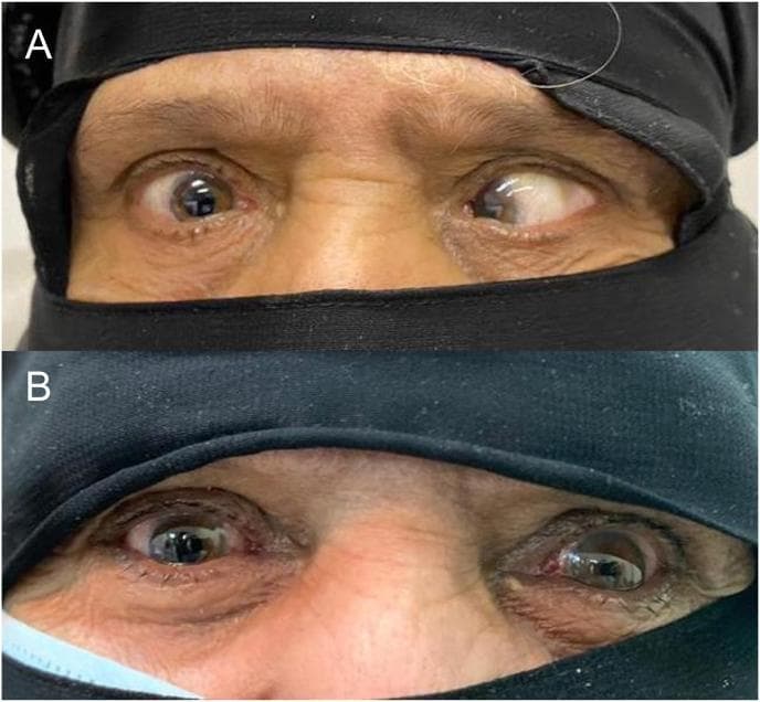 This clinical comparison photograph illustrates the preoperative and postoperative results of surgical correction for a complex strabismus case, specifically high myopic esotropia (Heavy Eye Syndrome).
Image A (top) displays the preoperative state in primary gaze, showing severe large-angle esotropia (inward deviation) of both eyes. The right eye exhibits a nasal shift, while the left eye shows an extreme nasal deviation with significant scleral exposure temporally, consistent with a measured angle of >90 prism diopters.
Image B (bottom) shows the patient four weeks post-surgery following bilateral loop myopexy (Yokoyama procedure) and medial rectus recession. The alignment is markedly improved; the large-angle esotropia is resolved, replaced by a mild, clinically acceptable exotropia (outward deviation) in the primary position. The clinical features demonstrate the successful repositioning of the globe and extraocular muscle paths (Superior Rectus and Lateral Rectus) to restore central alignment in a patient with a history of high myopia and prior retinal detachment surgery.