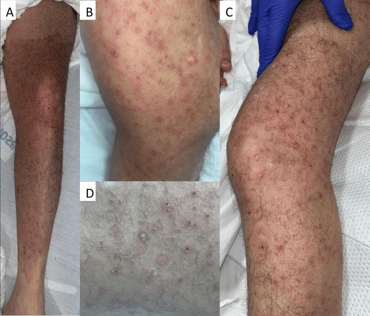 Clinical photograph of a 45-year-old male's left lower extremity demonstrating a complex dermatologic presentation involving co-infection of Herpes Zoster (HZ) and Majocchi's granuloma (MG). Panels A and B show the initial presentation, characterized by a well-demarcated, confluent erythematous plaque extending from the proximal thigh to the ankle. Within the plaque are visible erythematous papules, vesicles, and crusted erosions. Panels C and D illustrate the progression after 24 hours of IV acyclovir treatment, highlighting more prominent erythematous, scaly, annular papules and crusted red perifollicular lesions. The morphology exhibits both a dermatomal distribution suggestive of Varicella-Zoster Virus (VZV) and follicular involvement indicative of a deep fungal infection (Majocchi's granuloma). This comparison illustrates the diagnostic challenge when viral and fungal pathologies coexist in an immunocompromised patient, demonstrating how treatment for one condition (acyclovir) can make the features of the underlying fungal component more visually distinct.