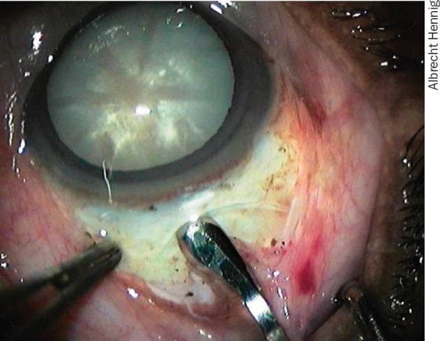 This clinical photograph captures a surgical step during an ophthalmological procedure, likely Manual Small Incision Cataract Surgery (MSICS). The image demonstrates the stabilization of the globe using metallic toothed forceps applied to the superior sclera. A 'frown-shaped' scleral tunnel incision is visible, with surgical instruments being used to create or manage the tunnel architecture. The central eye feature is a mature cataract, characterized by a dense, opaque, milky-white crystalline lens visible through the pupil. The conjunctiva and episclera show mild surgical trauma and injection (redness) typical of the intraoperative phase. The educational focus of the image is on the technique of firm scleral fixation required to ensure a stable operative field during the construction of the incision. Key anatomical structures shown include the limbus, sclera, cornea, and the opacified lens. This material is relevant for ophthalmic surgical training and understanding cataract extraction techniques.