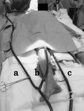 A clinical photograph illustrating a patient in a supine position undergoing Venoarterial-Venous Extracorporeal Membrane Oxygenation (VAV ECMO). The image highlights the configuration of three primary cannulas: (a) a return cannula inserted into the right internal jugular vein for cephalic/right atrial oxygenated blood delivery; (b) a return cannula inserted into the right femoral artery for systemic support; and (c) a large-bore drainage cannula inserted into the right femoral vein to collect deoxygenated blood for the extracorporeal circuit. Visible external components include medical-grade reinforced tubing, surgical clamps used for flow control, and transparent dressings at the femoral insertion sites. This setup demonstrates a transitional or hybrid ECMO configuration typically utilized when both cardiac and advanced respiratory support are required concurrently. The medical professional's hand near the upper junction indicates active monitoring or adjustment of the circuit branch. The arrangement exemplifies high-acuity critical care management of cardiogenic shock and respiratory failure.