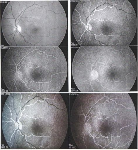 Diagnostic Imaging: A series of six fundus fluorescein angiography (FFA) images of the left eye, capturing the arterial, venous, and late phases of retinal circulation. The images demonstrate the chronological transit of fluorescein dye through the retinal vasculature, emanating from the optic disc toward the macula and peripheral retina. Key findings include notable venous tortuosity across the vascular arcades. The initial frames show early arterial filling and the beginning of the laminar venous flow, while middle and late-phase images show full venous filling and diffuse staining of the optic disc. No obvious areas of capillary non-perfusion or retinal ischemia are visible in this specific series. The foveal avascular zone (FAZ) remains well-defined and dark throughout the sequences. This imaging series is used in ophthalmology to evaluate retinal perfusion, vascular integrity, and to screen for complications related to systemic diseases such as sickle cell retinopathy.