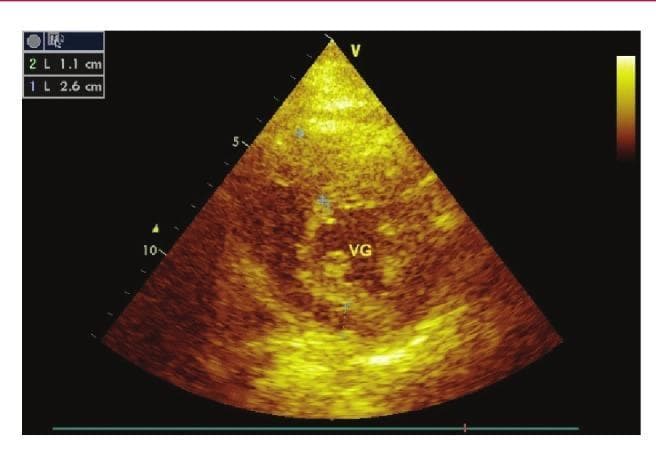 Diagnostic ultrasound image showing a transthoracic echocardiogram in a parasternal short-axis (PSAX) view at the level of the papillary muscles. The image demonstrates hallmark features of Hypertrophic Cardiomyopathy (HCM) in a 27-year-old patient. A significant asymmetric septal hypertrophy is visualized, with on-screen electronic calipers measuring the interventricular septum at 2.6 cm (26 mm). In contrast, the posterior wall measurement is marked at 1.1 cm (11 mm), resulting in a septal-to-posterior wall ratio of approximately 2.36, well above the clinical threshold for asymmetric hypertrophy. The left ventricular (VG) cavity appears reduced in size due to the encroaching hypertrophied myocardium. The myocardial texture is heterogeneous and echogenic, typical of fiber disarray seen in HCM. This clinical photograph is used to illustrate cardiac structural remodeling and the diagnostic criteria for cardiomyopathy in cardiology education.