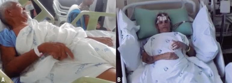 This clinical photograph consists of two panels (A and B) showcasing ictal manifestations of Faciobrachial Dystonic Seizures (FBDS) in two different patients, a pathognomonic sign of anti-LGI1 encephalitis. Panel A displays an elderly male patient in a semi-recumbent hospital bed position exhibiting classic ictal features: unilateral facial grimacing with an open-mouthed expression and concurrent dystonic posturing of the right upper extremity, characterized by elbow flexion and a clenched hand. Panel B shows a female patient undergoing video-electroencephalography (VEEG) monitoring, indicated by the EEG electrodes and white adhesive patches visible on her forehead. She is positioned supine and displays a more subtle ictal phase with a neutral facial expression and bilateral upper limbs resting across the lower torso. The clinical context highlights these brief, stereotyped involuntary movements as critical diagnostic markers for autoimmune limbic encephalitis, often associated with hyponatremia and basal ganglia signal abnormalities on neuroimaging.