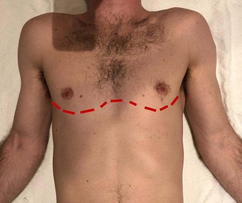 A clinical photograph of a male patient's torso in a supine position, serving as an anatomical diagram for surgical planning. A dashed red line is superimposed across the anterior chest to illustrate the approximate incision site for a bilateral clamshell thoracotomy. The line follows a transverse, slightly curved path through the fourth or fifth intercostal spaces, extending from the left anterior axillary line, passing inferior to the nipples/inframammary creases, and crossing the sternum to the right anterior axillary line. Anatomical landmarks visible include the pectoralis major muscles, sternum, and axillary regions. The image demonstrates the extensive surgical access required for emergency thoracic trauma management, such as hemorrhage control or cardiac procedures. The educational focus is on the surface anatomy and topographical mapping necessary for emergent surgical interventions in a trauma setting.