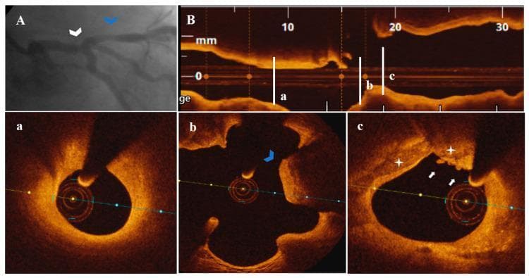 This composite medical image presents diagnostic findings for a 79-year-old patient with unstable angina pectoris (UAP), utilizing coronary angiography (CA) and optical coherence tomography (OCT). Panel A displays a CA of the left coronary system, identifying a borderline distal left main (LM) stenosis (white arrowhead) and a nonsignificant proximal left anterior descending (LAD) artery stenosis (blue arrowhead). Panel B provides a longitudinal OCT view of the LM-LAD segment with corresponding cross-sectional frames (a, b, c). Frame (a) shows a nonsignificant, uncomplicated LAD stenosis. Frame (b) highlights a calcified protrusion (blue arrowhead). Frame (c) demonstrates plaque erosion with superficial calcium protrusion (PE-SCP), indicated by white stars, accompanied by white thrombi (white arrows) within a nonsignificant LM stenosis (44.9% area stenosis). The imaging illustrates the utility of intravascular OCT in identifying specific high-risk plaque morphologies and thrombus formation in cases where angiography shows only borderline or nonsignificant coronary artery disease.