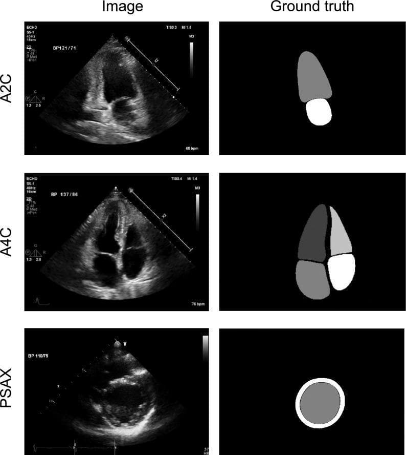 A multi-panel medical diagnostic graphic displaying standard 2D echocardiography views and their corresponding 'ground truth' segmentations for educational and machine-learning purposes. The images are organized in three rows representing primary echocardiographic orientations: Apical Two-Chamber (A2C), Apical Four-Chamber (A4C), and Parasternal Short Axis (PSAX) at the papillary muscle level. The left column shows the original grayscale B-mode ultrasound images, featuring anatomical landmarks such as the left ventricle (LV), right ventricle (RV), left atrium (LA), right atrium (RA), and interventricular septum. Overlaid metadata include heart rate (bpm) and blood pressure (BP) values. The right column displays expert-annotated segmentation masks where cardiac structures are color-coded as solid shapes: the LV cavity, LA cavity, RV cavity, and RA cavity in the A4C view; the LV and LA in the A2C view; and a circular cross-section of the LV myocardium and cavity in the PSAX view. This comparison highlights key anatomical boundaries used in clinical indices like ejection fraction (EF) and ventricular volume measurements.