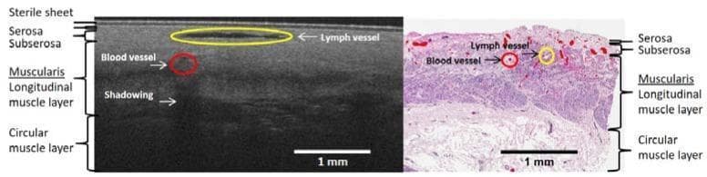 This dual-panel medical graphic provides a direct comparison between an optical coherence tomography (OCT) B-scan (left) and an H&E stained histology slide (right) of human gastric fundus tissue. Both panels illustrate the layered architecture of the gastric wall with corresponding labels. The tissue layers identified from the surface downward include the serosa and subserosa, followed by the muscularis propria, which is subdivided into the longitudinal muscle layer and the circular muscle layer. In the OCT B-scan, microvascular structures are visible, including a lymph vessel appearing as a low-scattering (dark) horizontal void and a blood vessel marked with a red circle. Vertical shadowing is noted beneath the blood vessel due to signal attenuation. In the histopathology slide, blood vessels are highlighted in red and lymph vessels in yellow, primarily localized within the serosa and subserosa layers. A sterile sheet artifact is visible on the OCT surface. Scale bars in both panels represent 1 mm, emphasizing the microscale resolution used to assess microvasculature and tissue morphology at the end of a gastric tube.